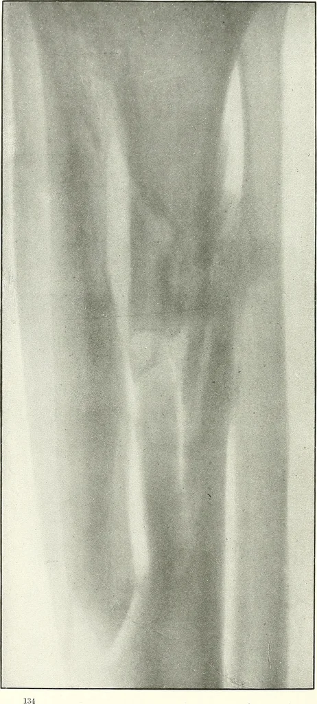 An illustration from Gunshot Roentgenograms : Acollection of Roentgenograms taken in Constantinople during the Turko-Balkan War, 1912-1913, illustrating some gunshot wounds in the Turkish Army, 1916, leaf 138