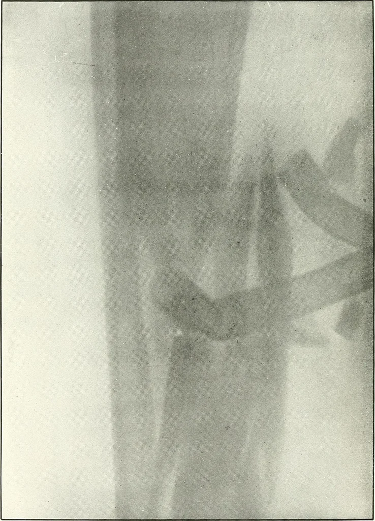 An illustration from Gunshot Roentgenograms : Acollection of Roentgenograms taken in Constantinople during the Turko-Balkan War, 1912-1913, illustrating some gunshot wounds in the Turkish Army, 1916, leaf 140