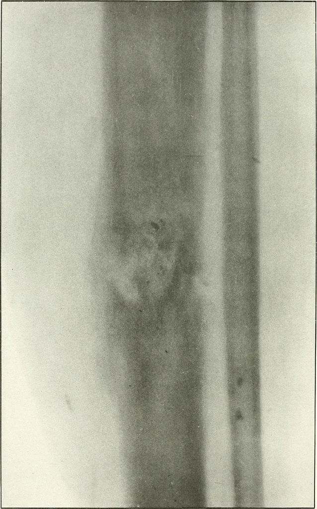 An illustration from Gunshot Roentgenograms : Acollection of Roentgenograms taken in Constantinople during the Turko-Balkan War, 1912-1913, illustrating some gunshot wounds in the Turkish Army, 1916, leaf 142