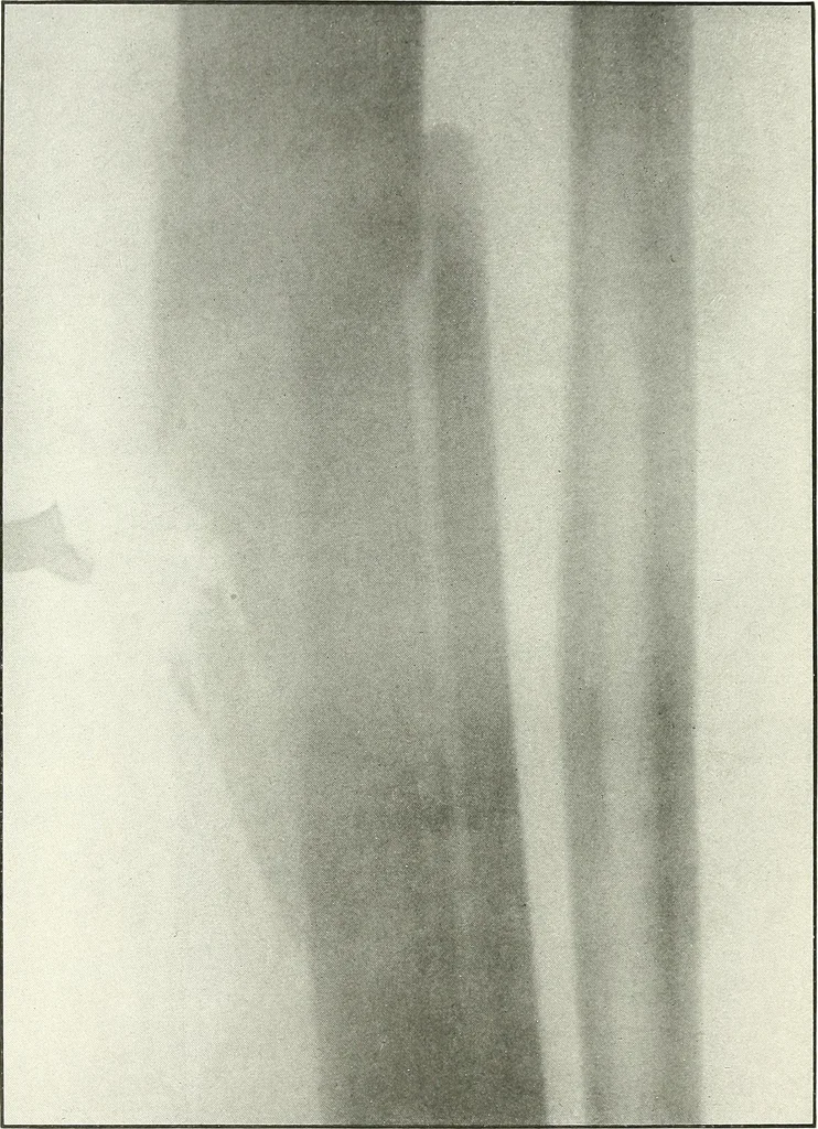 An illustration from Gunshot Roentgenograms : Acollection of Roentgenograms taken in Constantinople during the Turko-Balkan War, 1912-1913, illustrating some gunshot wounds in the Turkish Army, 1916, leaf 146