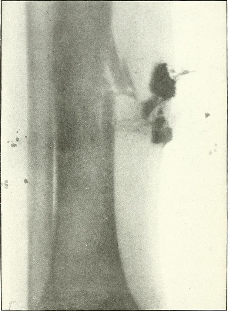An illustration from Gunshot Roentgenograms : Acollection of Roentgenograms taken in Constantinople during the Turko-Balkan War, 1912-1913, illustrating some gunshot wounds in the Turkish Army, 1916, leaf 150