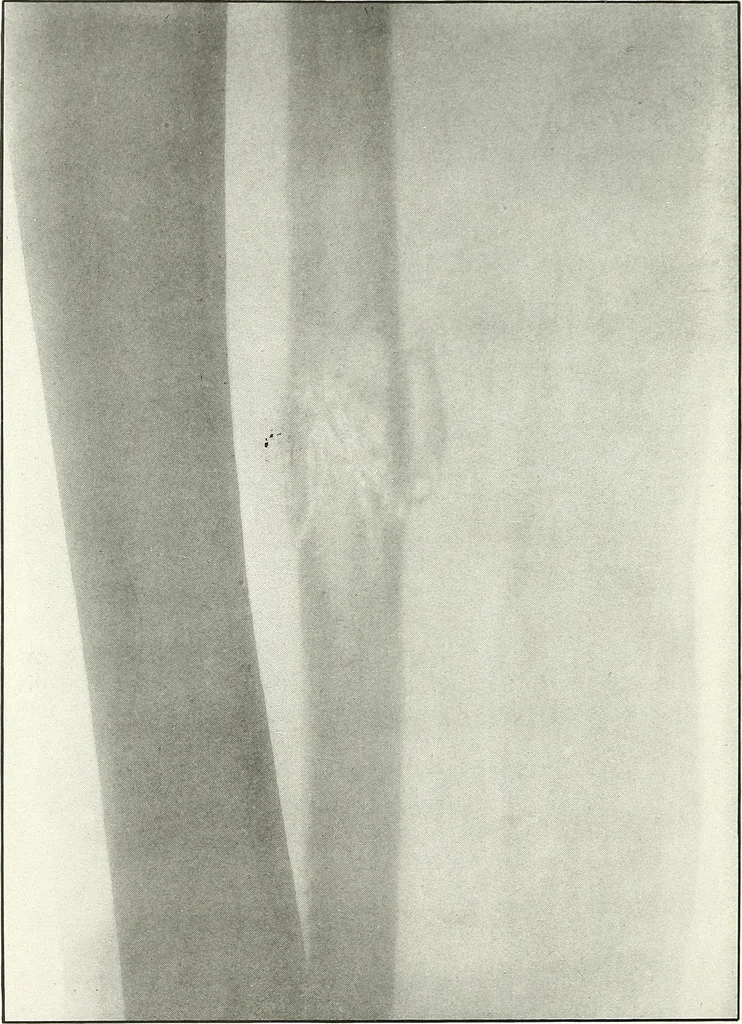 An illustration from Gunshot Roentgenograms : Acollection of Roentgenograms taken in Constantinople during the Turko-Balkan War, 1912-1913, illustrating some gunshot wounds in the Turkish Army, 1916, leaf 156