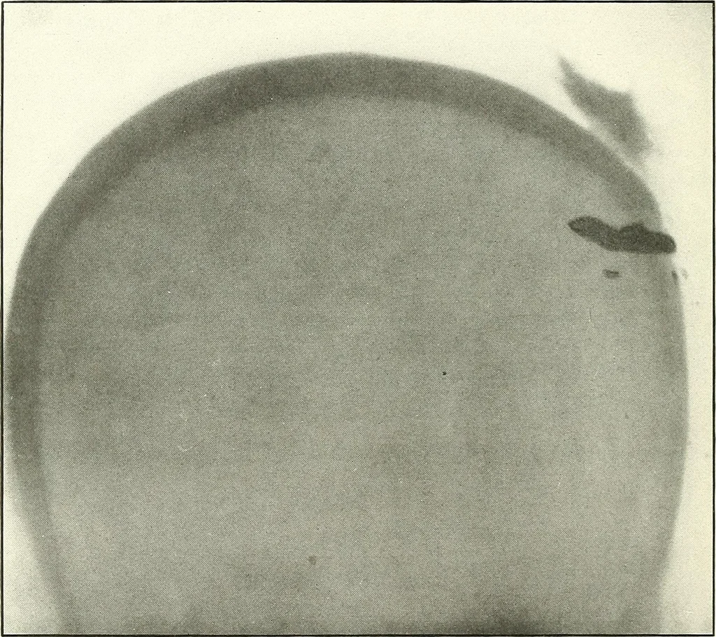 An illustration from Gunshot Roentgenograms : Acollection of Roentgenograms taken in Constantinople during the Turko-Balkan War, 1912-1913, illustrating some gunshot wounds in the Turkish Army, 1916, leaf 16