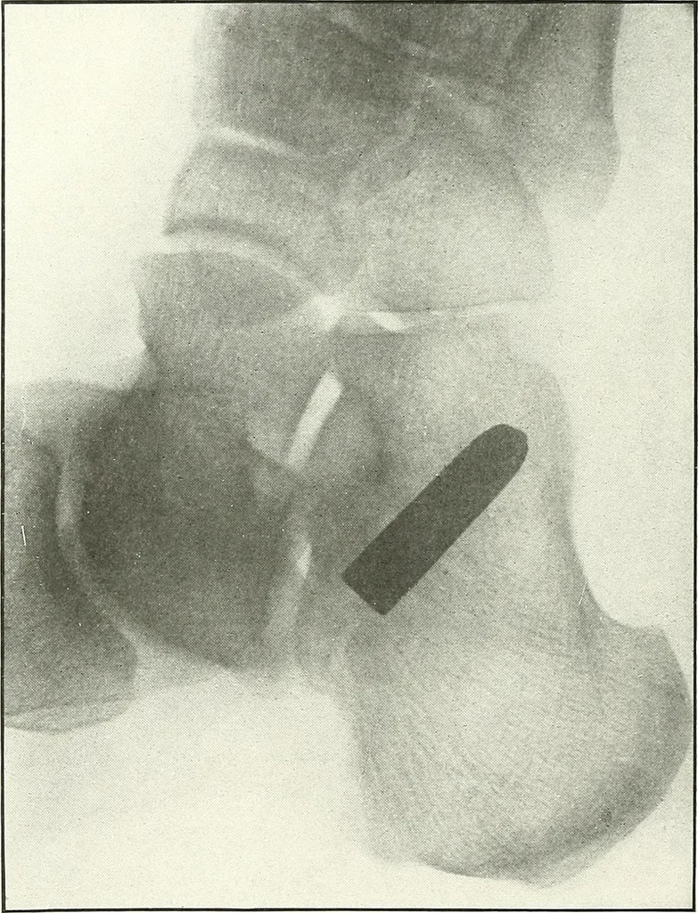 An illustration from Gunshot Roentgenograms : Acollection of Roentgenograms taken in Constantinople during the Turko-Balkan War, 1912-1913, illustrating some gunshot wounds in the Turkish Army, 1916, leaf 160