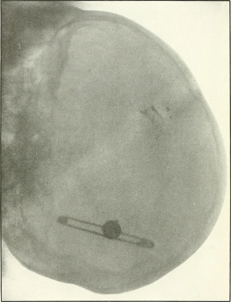 An illustration from Gunshot Roentgenograms : Acollection of Roentgenograms taken in Constantinople during the Turko-Balkan War, 1912-1913, illustrating some gunshot wounds in the Turkish Army, 1916, leaf 164
