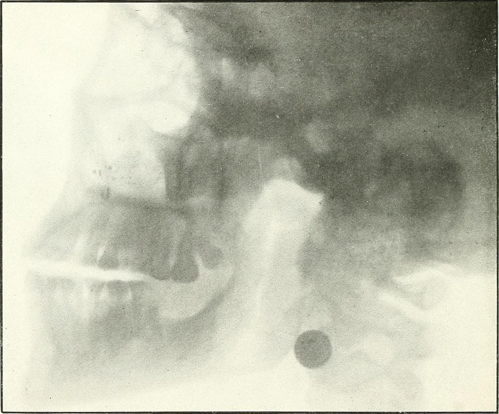 An illustration from Gunshot Roentgenograms : Acollection of Roentgenograms taken in Constantinople during the Turko-Balkan War, 1912-1913, illustrating some gunshot wounds in the Turkish Army, 1916, leaf 172