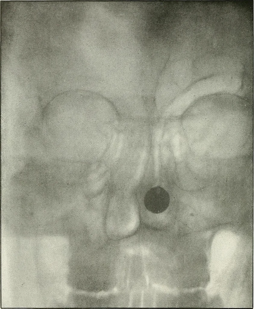 An illustration from Gunshot Roentgenograms : Acollection of Roentgenograms taken in Constantinople during the Turko-Balkan War, 1912-1913, illustrating some gunshot wounds in the Turkish Army, 1916, leaf 174