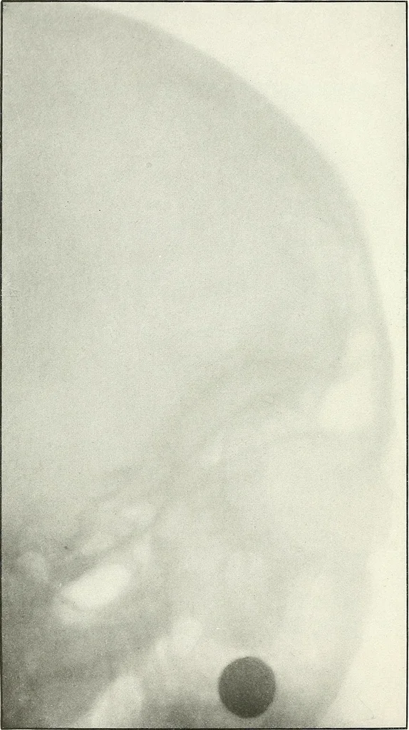 An illustration from Gunshot Roentgenograms : Acollection of Roentgenograms taken in Constantinople during the Turko-Balkan War, 1912-1913, illustrating some gunshot wounds in the Turkish Army, 1916, leaf 176