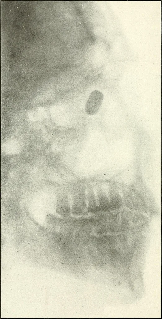 An illustration from Gunshot Roentgenograms : Acollection of Roentgenograms taken in Constantinople during the Turko-Balkan War, 1912-1913, illustrating some gunshot wounds in the Turkish Army, 1916, leaf 18