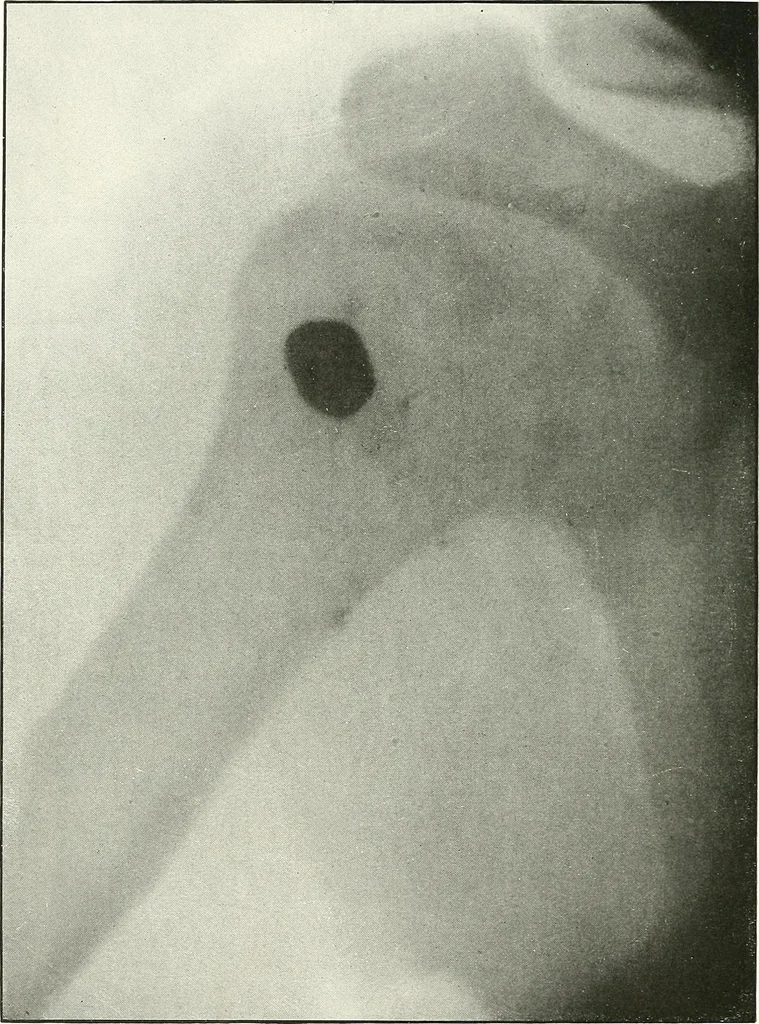 An illustration from Gunshot Roentgenograms : Acollection of Roentgenograms taken in Constantinople during the Turko-Balkan War, 1912-1913, illustrating some gunshot wounds in the Turkish Army, 1916, leaf 182