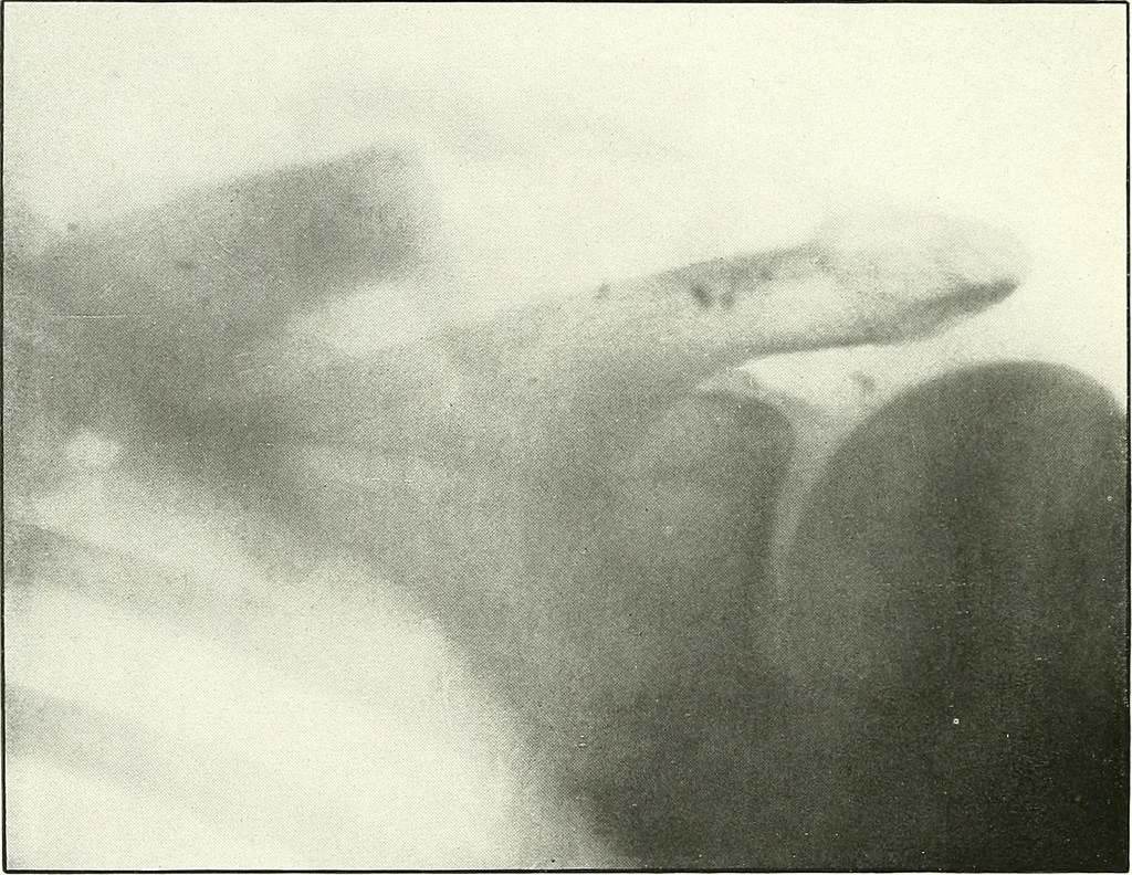 An illustration from Gunshot Roentgenograms : Acollection of Roentgenograms taken in Constantinople during the Turko-Balkan War, 1912-1913, illustrating some gunshot wounds in the Turkish Army, 1916, leaf 186