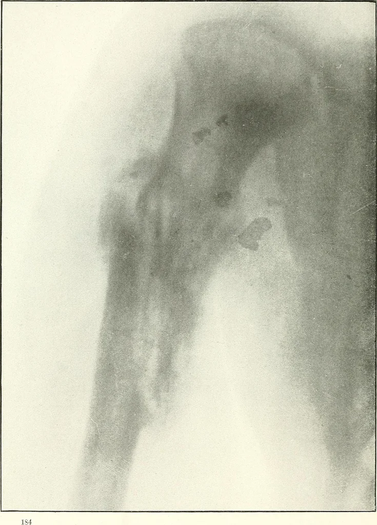 An illustration from Gunshot Roentgenograms : Acollection of Roentgenograms taken in Constantinople during the Turko-Balkan War, 1912-1913, illustrating some gunshot wounds in the Turkish Army, 1916, leaf 188