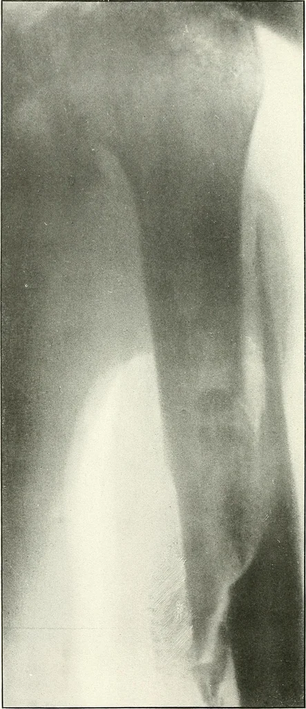 An illustration from Gunshot Roentgenograms : Acollection of Roentgenograms taken in Constantinople during the Turko-Balkan War, 1912-1913, illustrating some gunshot wounds in the Turkish Army, 1916, leaf 190