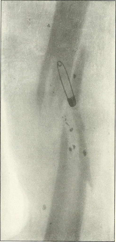 An illustration from Gunshot Roentgenograms : Acollection of Roentgenograms taken in Constantinople during the Turko-Balkan War, 1912-1913, illustrating some gunshot wounds in the Turkish Army, 1916, leaf 194
