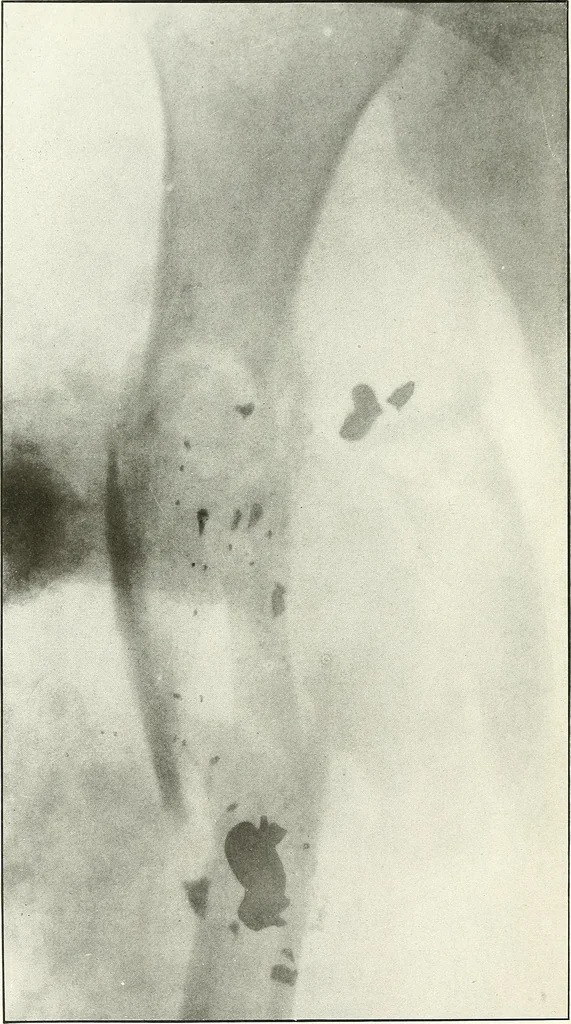 An illustration from Gunshot Roentgenograms : Acollection of Roentgenograms taken in Constantinople during the Turko-Balkan War, 1912-1913, illustrating some gunshot wounds in the Turkish Army, 1916, leaf 198