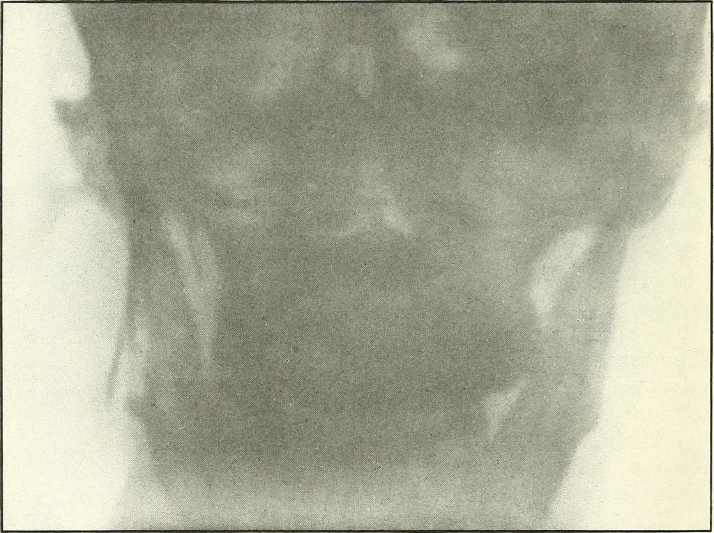 An illustration from Gunshot Roentgenograms : Acollection of Roentgenograms taken in Constantinople during the Turko-Balkan War, 1912-1913, illustrating some gunshot wounds in the Turkish Army, 1916, leaf 20