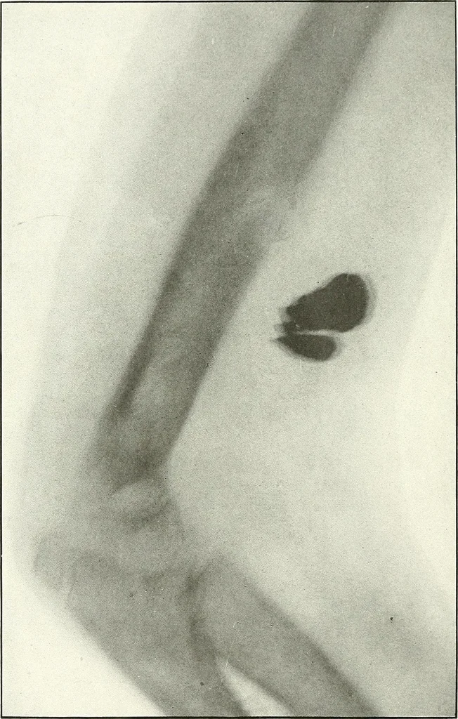 An illustration from Gunshot Roentgenograms : Acollection of Roentgenograms taken in Constantinople during the Turko-Balkan War, 1912-1913, illustrating some gunshot wounds in the Turkish Army, 1916, leaf 204