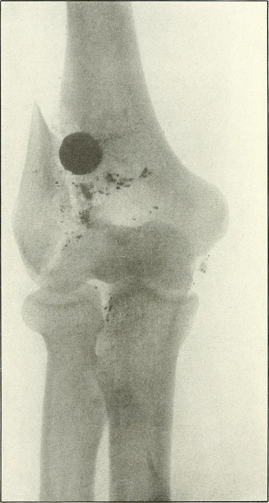 An illustration from Gunshot Roentgenograms : Acollection of Roentgenograms taken in Constantinople during the Turko-Balkan War, 1912-1913, illustrating some gunshot wounds in the Turkish Army, 1916, leaf 210