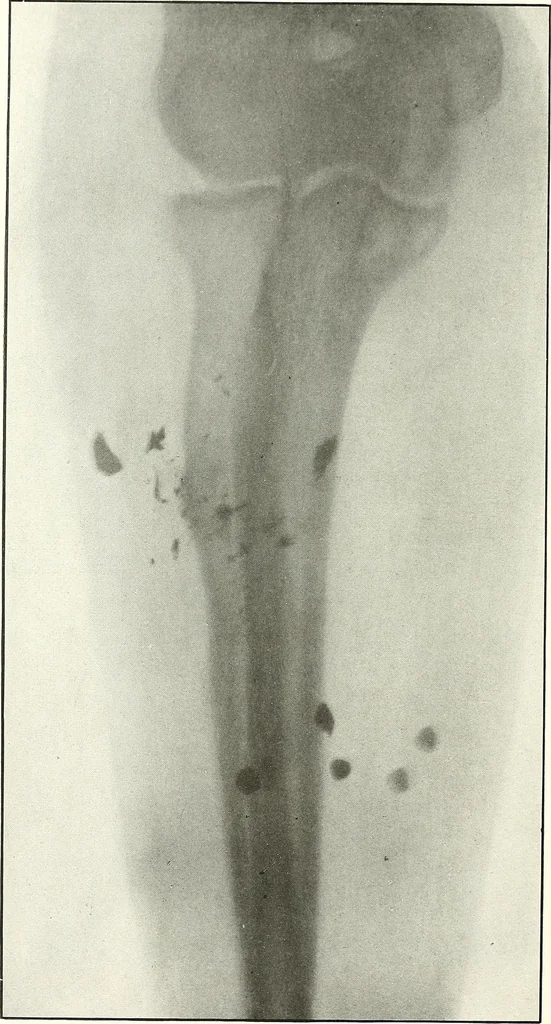 An illustration from Gunshot Roentgenograms : Acollection of Roentgenograms taken in Constantinople during the Turko-Balkan War, 1912-1913, illustrating some gunshot wounds in the Turkish Army, 1916, leaf 218