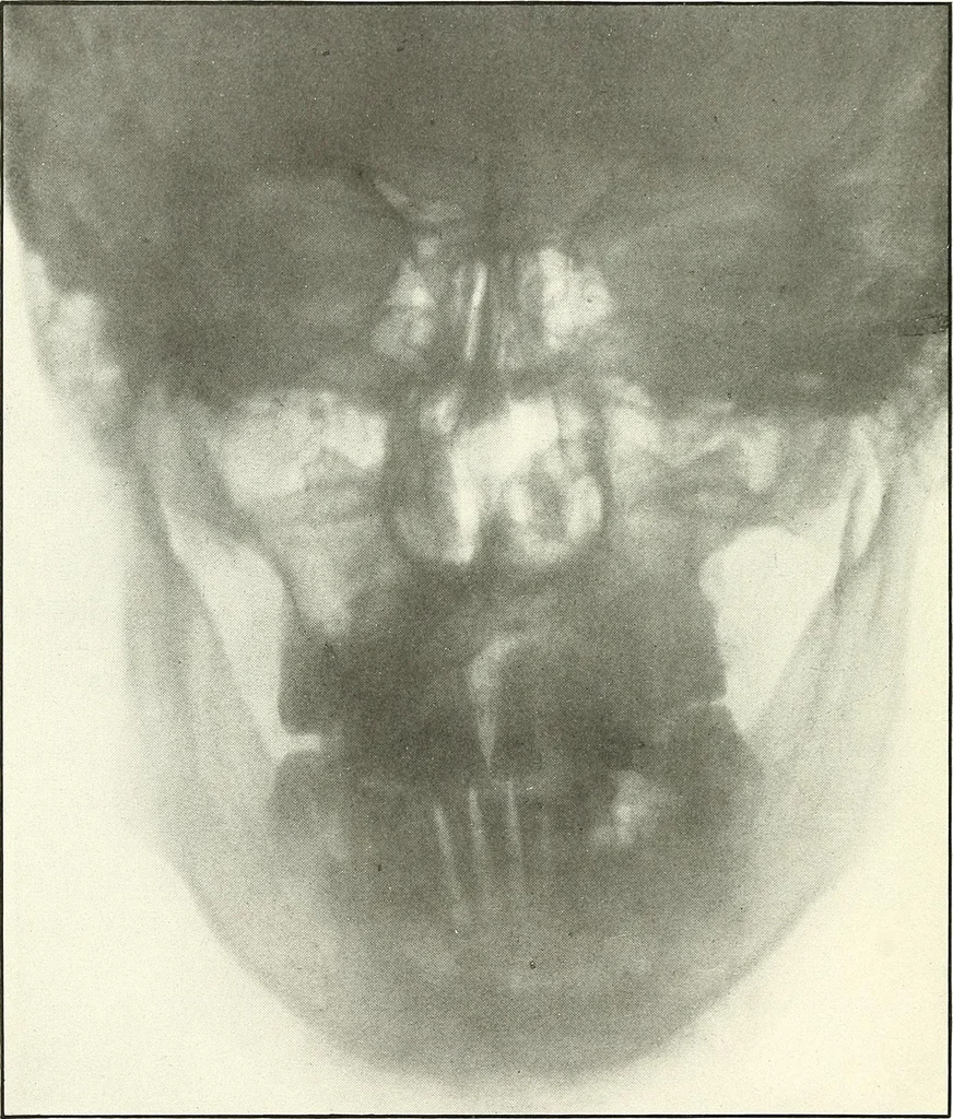 An illustration from Gunshot Roentgenograms : Acollection of Roentgenograms taken in Constantinople during the Turko-Balkan War, 1912-1913, illustrating some gunshot wounds in the Turkish Army, 1916, leaf 22