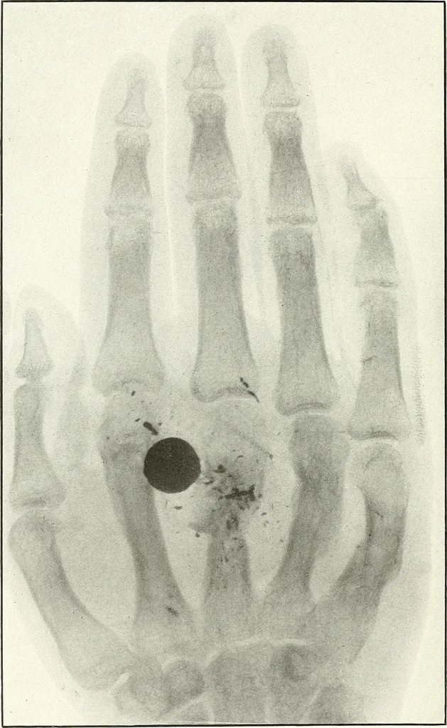 An illustration from Gunshot Roentgenograms : Acollection of Roentgenograms taken in Constantinople during the Turko-Balkan War, 1912-1913, illustrating some gunshot wounds in the Turkish Army, 1916, leaf 224