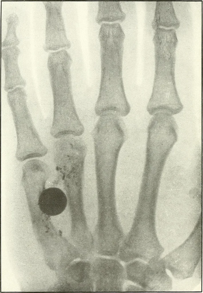 An illustration from Gunshot Roentgenograms : Acollection of Roentgenograms taken in Constantinople during the Turko-Balkan War, 1912-1913, illustrating some gunshot wounds in the Turkish Army, 1916, leaf 226