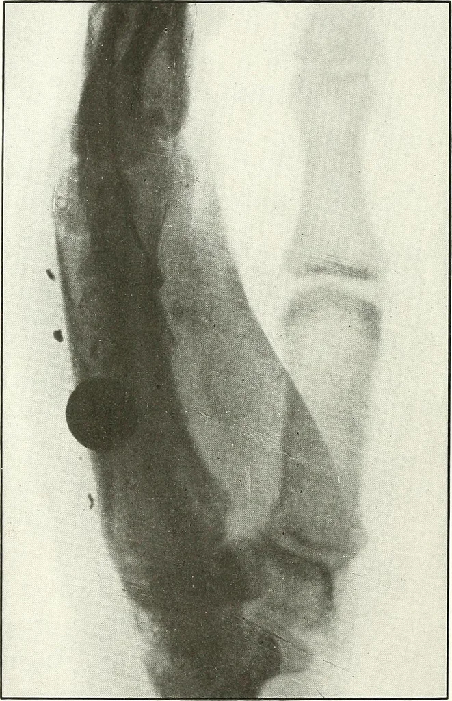 An illustration from Gunshot Roentgenograms : Acollection of Roentgenograms taken in Constantinople during the Turko-Balkan War, 1912-1913, illustrating some gunshot wounds in the Turkish Army, 1916, leaf 228