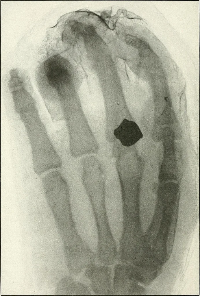 An illustration from Gunshot Roentgenograms : Acollection of Roentgenograms taken in Constantinople during the Turko-Balkan War, 1912-1913, illustrating some gunshot wounds in the Turkish Army, 1916, leaf 230