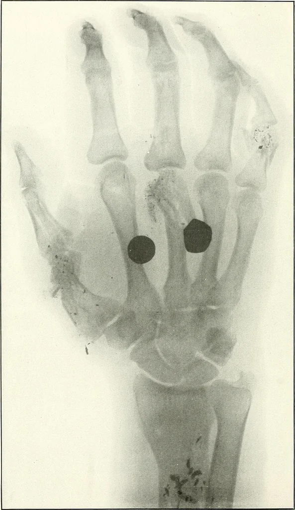 An illustration from Gunshot Roentgenograms : Acollection of Roentgenograms taken in Constantinople during the Turko-Balkan War, 1912-1913, illustrating some gunshot wounds in the Turkish Army, 1916, leaf 232