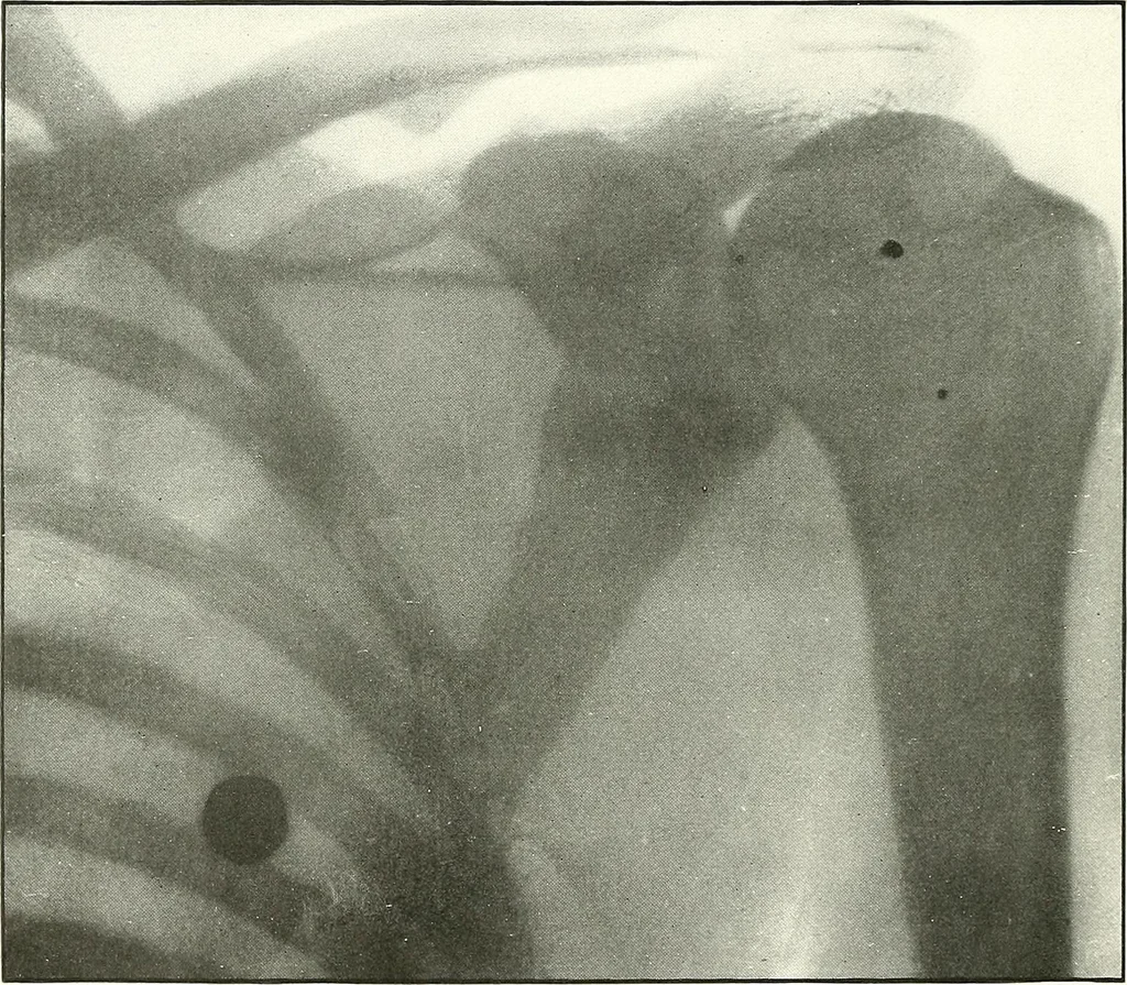An illustration from Gunshot Roentgenograms : Acollection of Roentgenograms taken in Constantinople during the Turko-Balkan War, 1912-1913, illustrating some gunshot wounds in the Turkish Army, 1916, leaf 234