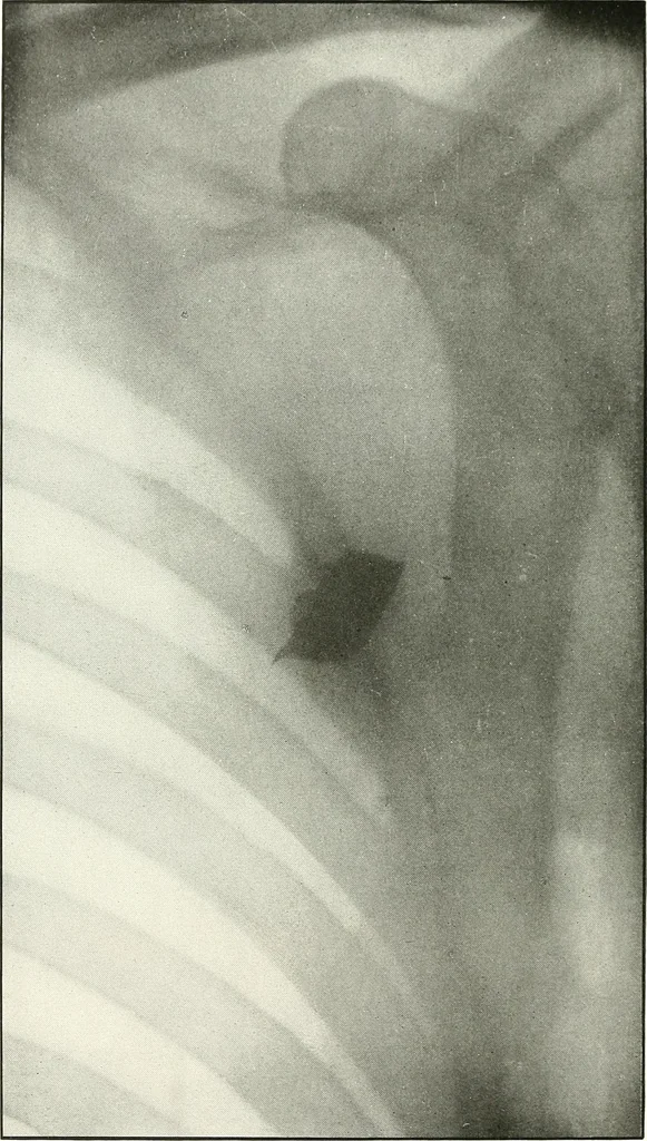 An illustration from Gunshot Roentgenograms : Acollection of Roentgenograms taken in Constantinople during the Turko-Balkan War, 1912-1913, illustrating some gunshot wounds in the Turkish Army, 1916, leaf 236