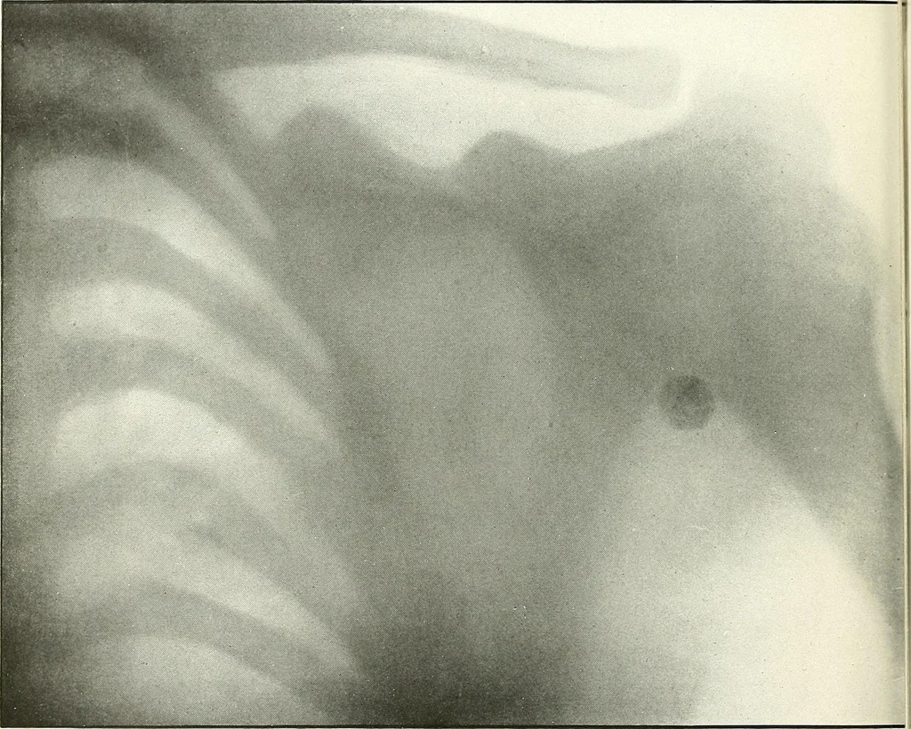 An illustration from Gunshot Roentgenograms : Acollection of Roentgenograms taken in Constantinople during the Turko-Balkan War, 1912-1913, illustrating some gunshot wounds in the Turkish Army, 1916, leaf 238