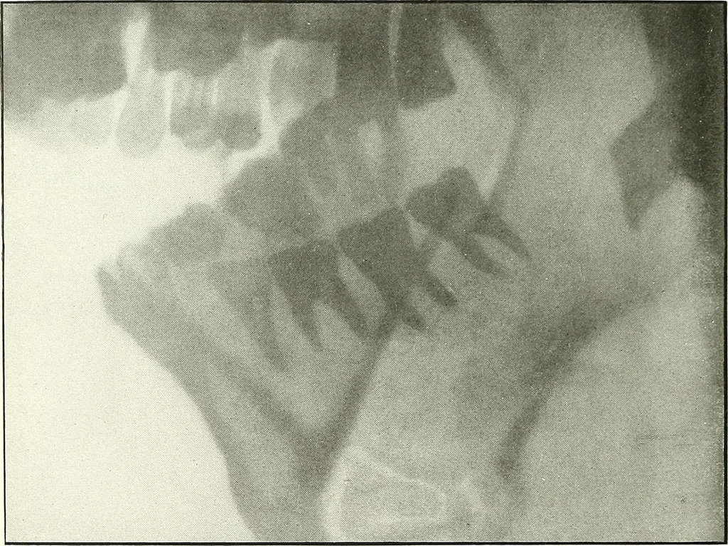 An illustration from Gunshot Roentgenograms : Acollection of Roentgenograms taken in Constantinople during the Turko-Balkan War, 1912-1913, illustrating some gunshot wounds in the Turkish Army, 1916, leaf 24