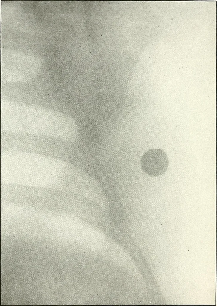 An illustration from Gunshot Roentgenograms : Acollection of Roentgenograms taken in Constantinople during the Turko-Balkan War, 1912-1913, illustrating some gunshot wounds in the Turkish Army, 1916, leaf 240