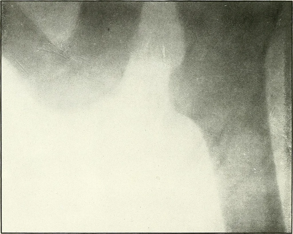 An illustration from Gunshot Roentgenograms : Acollection of Roentgenograms taken in Constantinople during the Turko-Balkan War, 1912-1913, illustrating some gunshot wounds in the Turkish Army, 1916, leaf 246