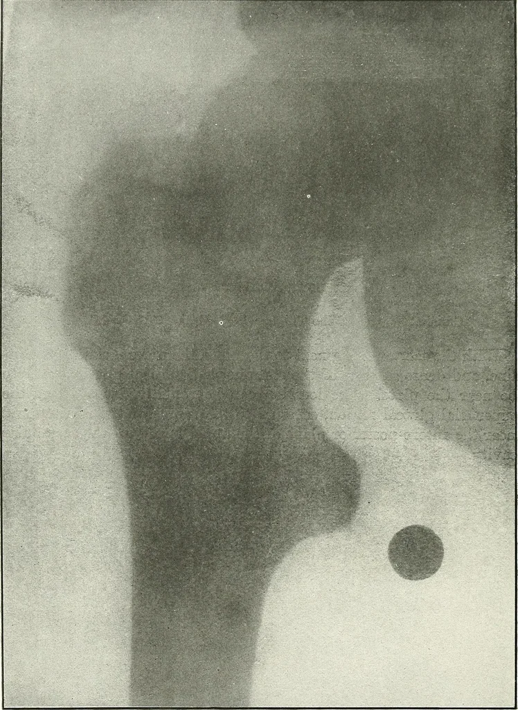 An illustration from Gunshot Roentgenograms : Acollection of Roentgenograms taken in Constantinople during the Turko-Balkan War, 1912-1913, illustrating some gunshot wounds in the Turkish Army, 1916, leaf 250