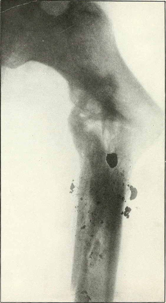 An illustration from Gunshot Roentgenograms : Acollection of Roentgenograms taken in Constantinople during the Turko-Balkan War, 1912-1913, illustrating some gunshot wounds in the Turkish Army, 1916, leaf 252