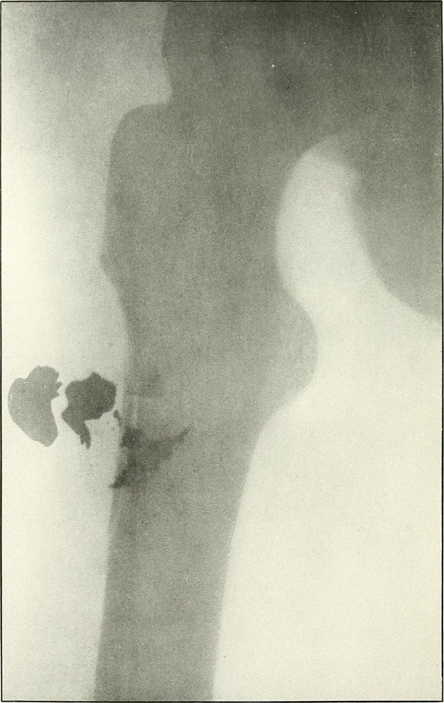 An illustration from Gunshot Roentgenograms : Acollection of Roentgenograms taken in Constantinople during the Turko-Balkan War, 1912-1913, illustrating some gunshot wounds in the Turkish Army, 1916, leaf 254