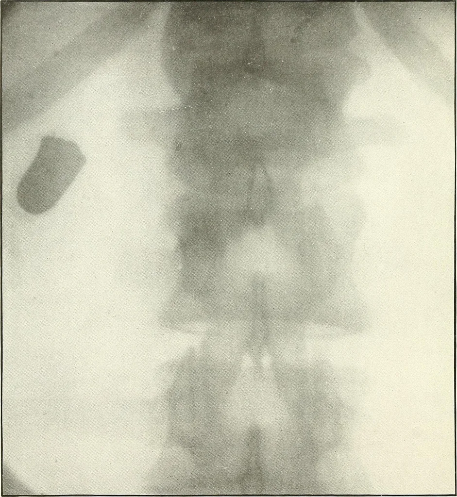 An illustration from Gunshot Roentgenograms : Acollection of Roentgenograms taken in Constantinople during the Turko-Balkan War, 1912-1913, illustrating some gunshot wounds in the Turkish Army, 1916, leaf 26