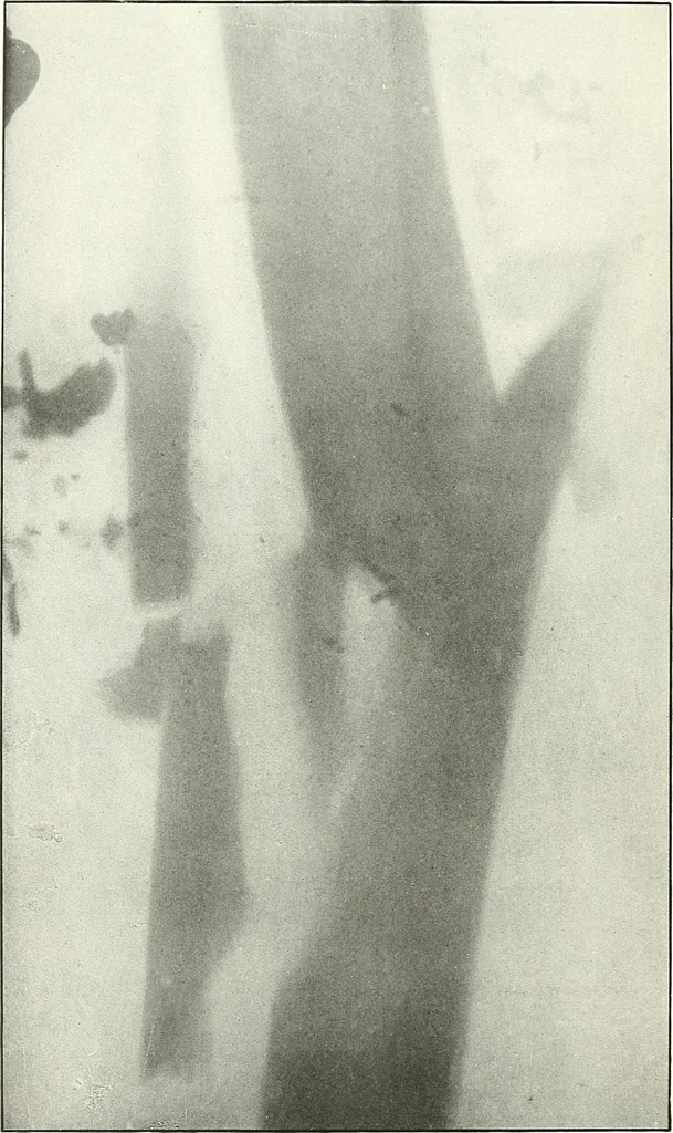 An illustration from Gunshot Roentgenograms : Acollection of Roentgenograms taken in Constantinople during the Turko-Balkan War, 1912-1913, illustrating some gunshot wounds in the Turkish Army, 1916, leaf 260