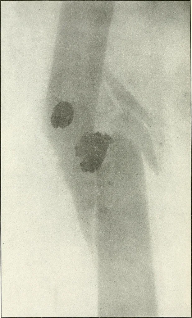 An illustration from Gunshot Roentgenograms : Acollection of Roentgenograms taken in Constantinople during the Turko-Balkan War, 1912-1913, illustrating some gunshot wounds in the Turkish Army, 1916, leaf 262
