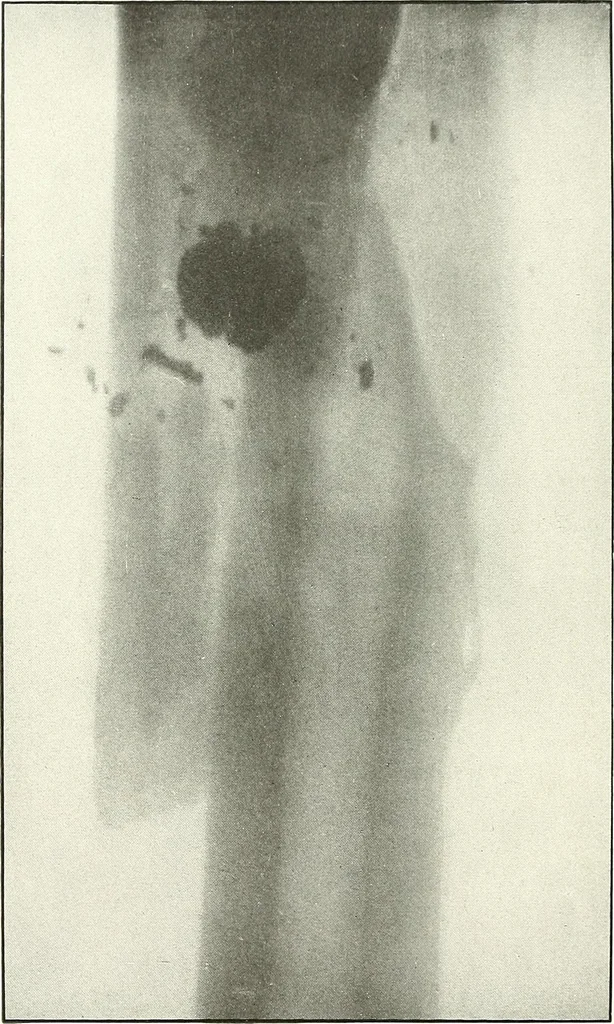 An illustration from Gunshot Roentgenograms : Acollection of Roentgenograms taken in Constantinople during the Turko-Balkan War, 1912-1913, illustrating some gunshot wounds in the Turkish Army, 1916, leaf 264