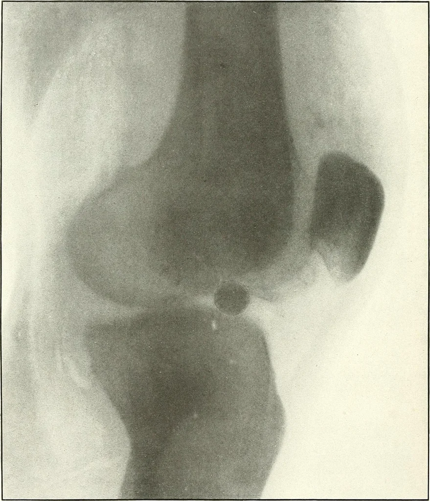 An illustration from Gunshot Roentgenograms : Acollection of Roentgenograms taken in Constantinople during the Turko-Balkan War, 1912-1913, illustrating some gunshot wounds in the Turkish Army, 1916, leaf 272