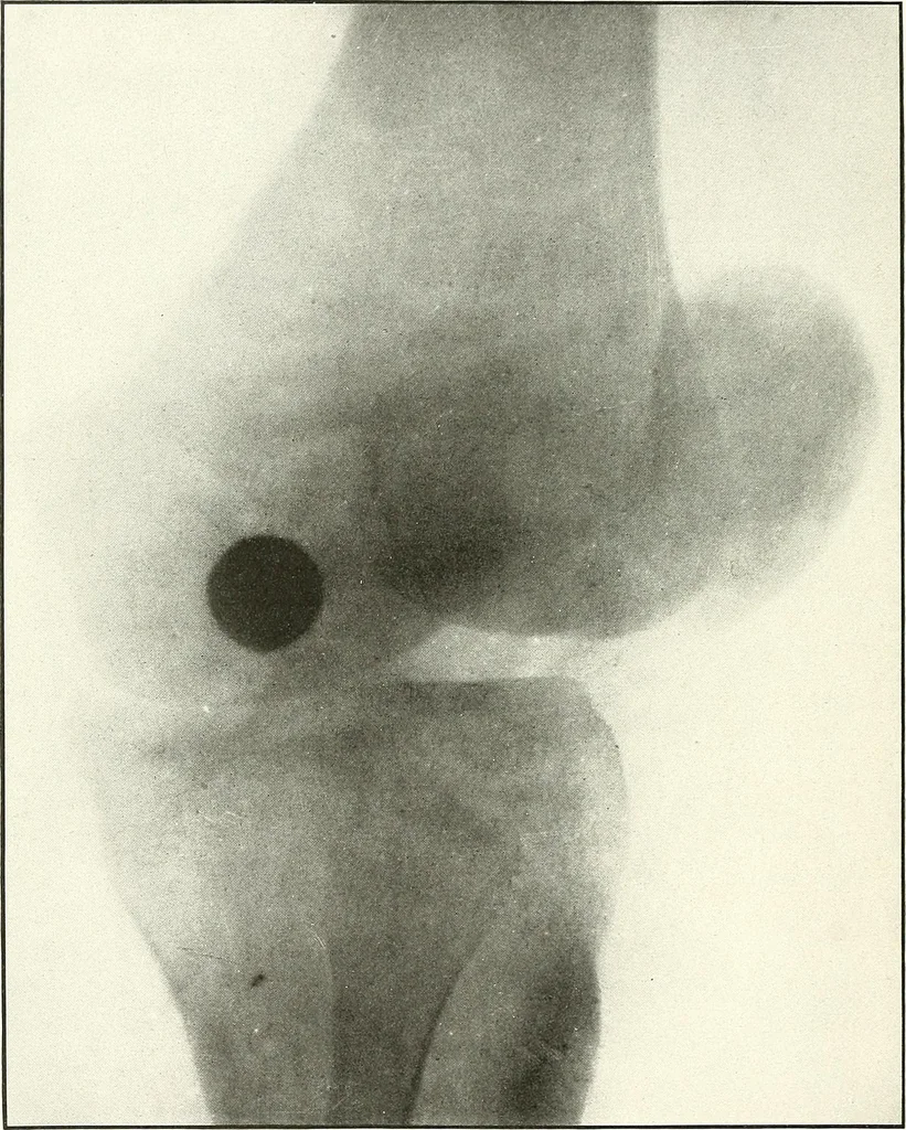An illustration from Gunshot Roentgenograms : Acollection of Roentgenograms taken in Constantinople during the Turko-Balkan War, 1912-1913, illustrating some gunshot wounds in the Turkish Army, 1916, leaf 274