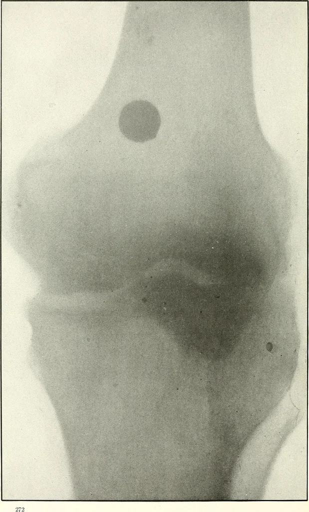 An illustration from Gunshot Roentgenograms : Acollection of Roentgenograms taken in Constantinople during the Turko-Balkan War, 1912-1913, illustrating some gunshot wounds in the Turkish Army, 1916, leaf 276