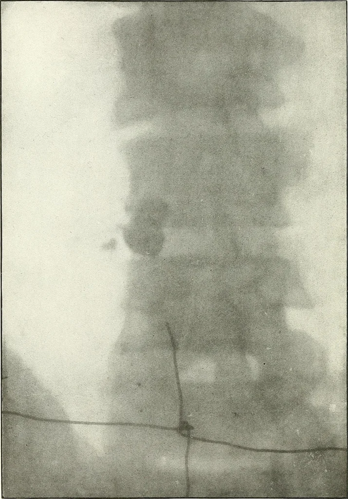 An illustration from Gunshot Roentgenograms : Acollection of Roentgenograms taken in Constantinople during the Turko-Balkan War, 1912-1913, illustrating some gunshot wounds in the Turkish Army, 1916, leaf 28