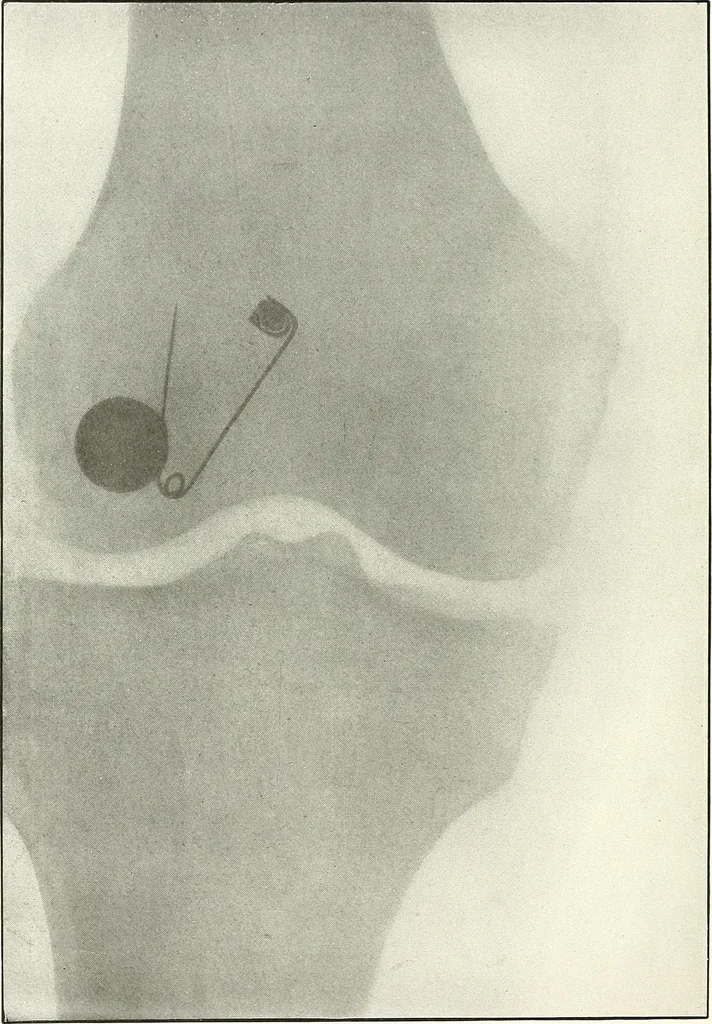 An illustration from Gunshot Roentgenograms : Acollection of Roentgenograms taken in Constantinople during the Turko-Balkan War, 1912-1913, illustrating some gunshot wounds in the Turkish Army, 1916, leaf 280