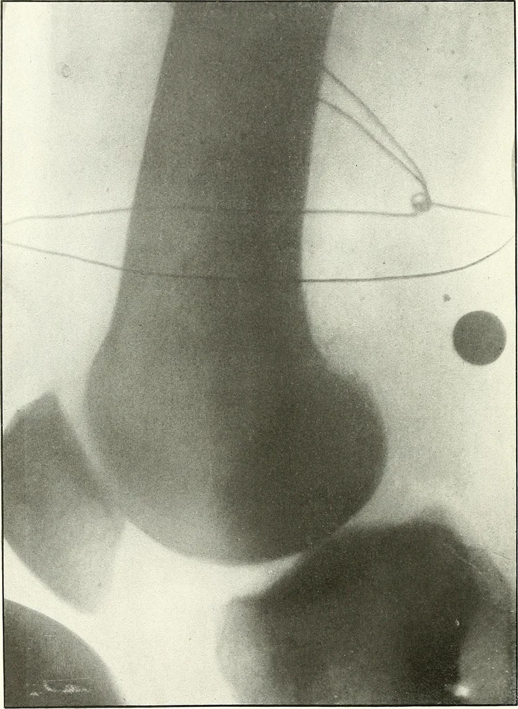 An illustration from Gunshot Roentgenograms : Acollection of Roentgenograms taken in Constantinople during the Turko-Balkan War, 1912-1913, illustrating some gunshot wounds in the Turkish Army, 1916, leaf 282