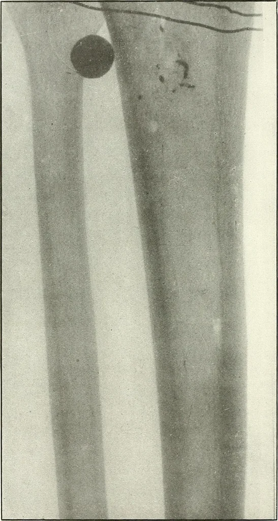 An illustration from Gunshot Roentgenograms : Acollection of Roentgenograms taken in Constantinople during the Turko-Balkan War, 1912-1913, illustrating some gunshot wounds in the Turkish Army, 1916, leaf 284