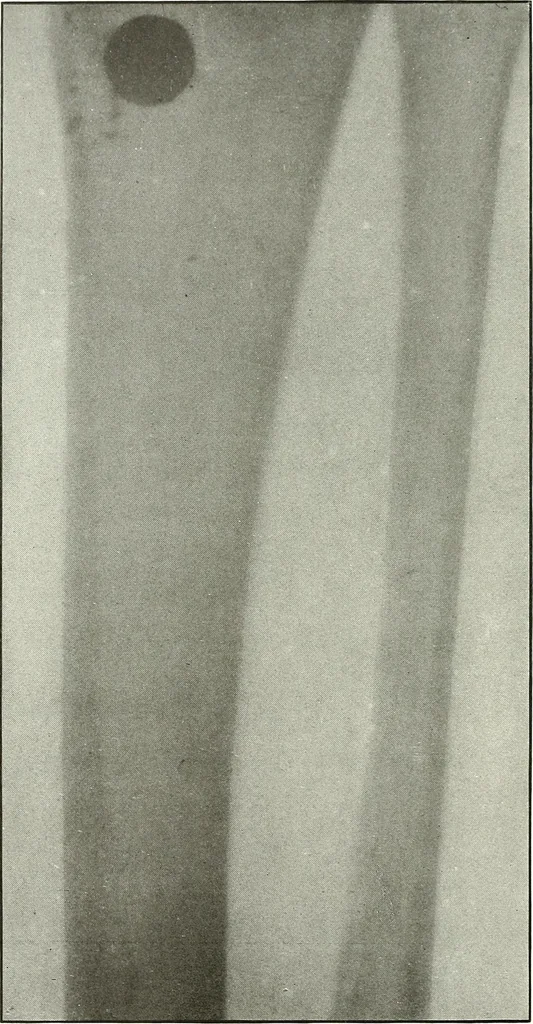 An illustration from Gunshot Roentgenograms : Acollection of Roentgenograms taken in Constantinople during the Turko-Balkan War, 1912-1913, illustrating some gunshot wounds in the Turkish Army, 1916, leaf 286